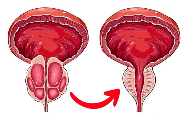 L’aliment qui réduit une prostate hypertrophiée